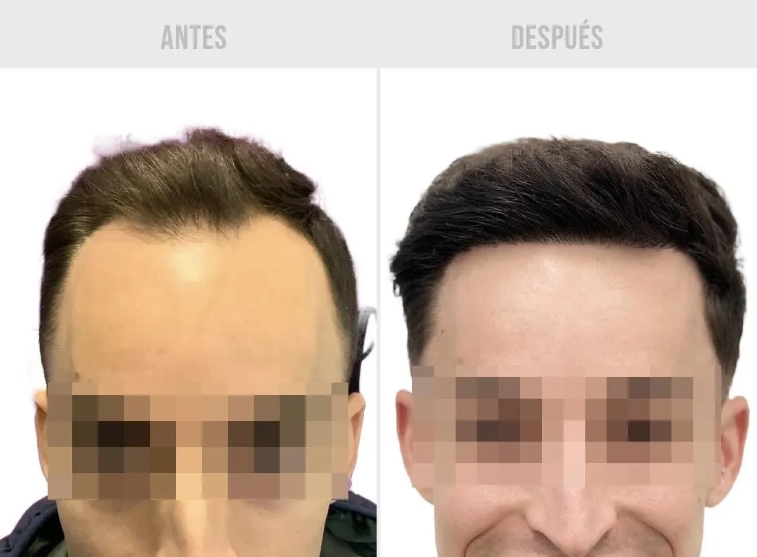 Comparativa de antes y después de injerto capilar, caso 1