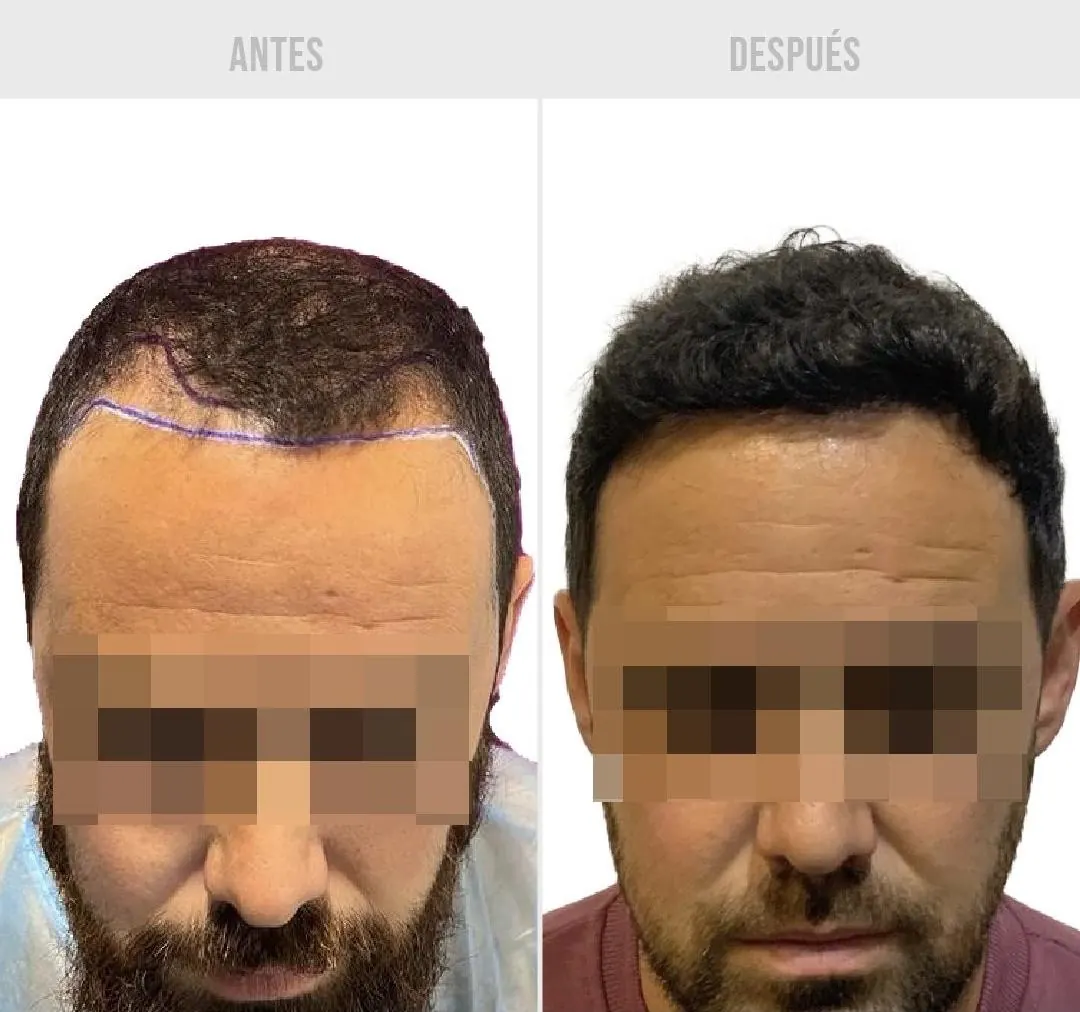 Comparativa de antes y después de injerto capilar, caso 2