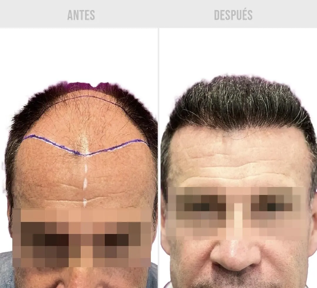 Comparativa de antes y después de injerto capilar, caso 3